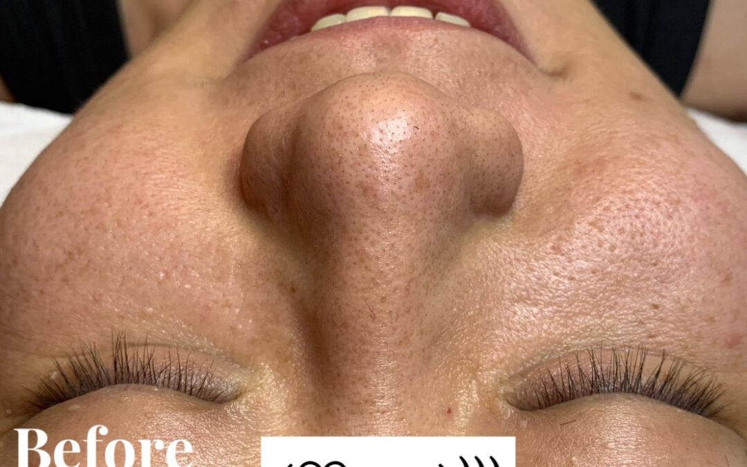 男生鼻子黑頭怎麼處理？一直清不掉的原因其實不是你不乾淨