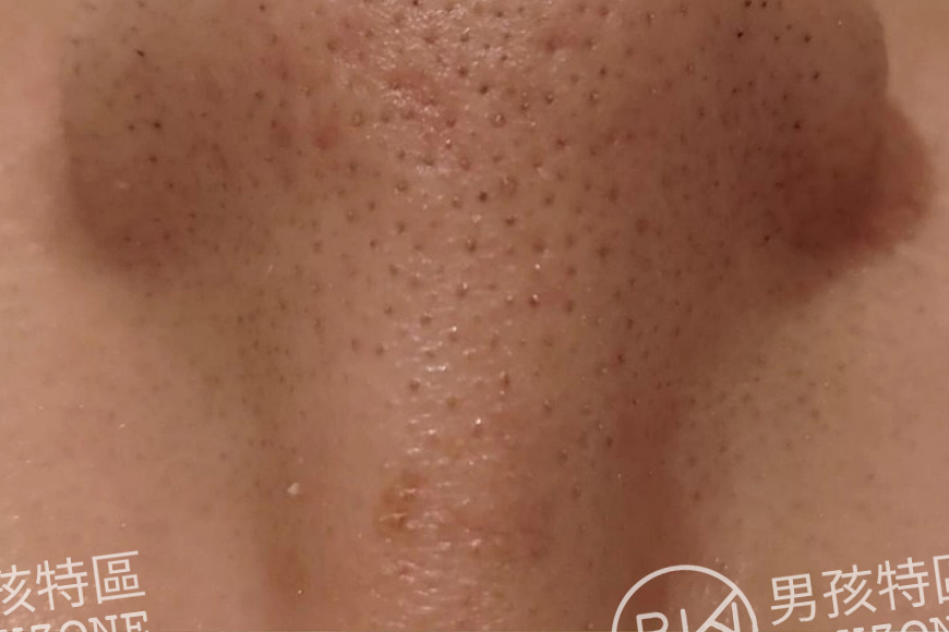 粉刺為什麼一直長？男生最常忽略的5個真正原因